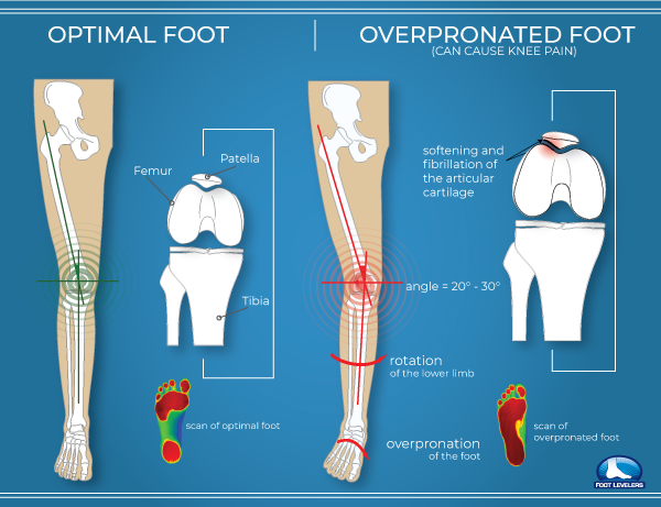 Custom Made Orthotics | Foot Levelers