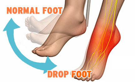 drop foot illustration